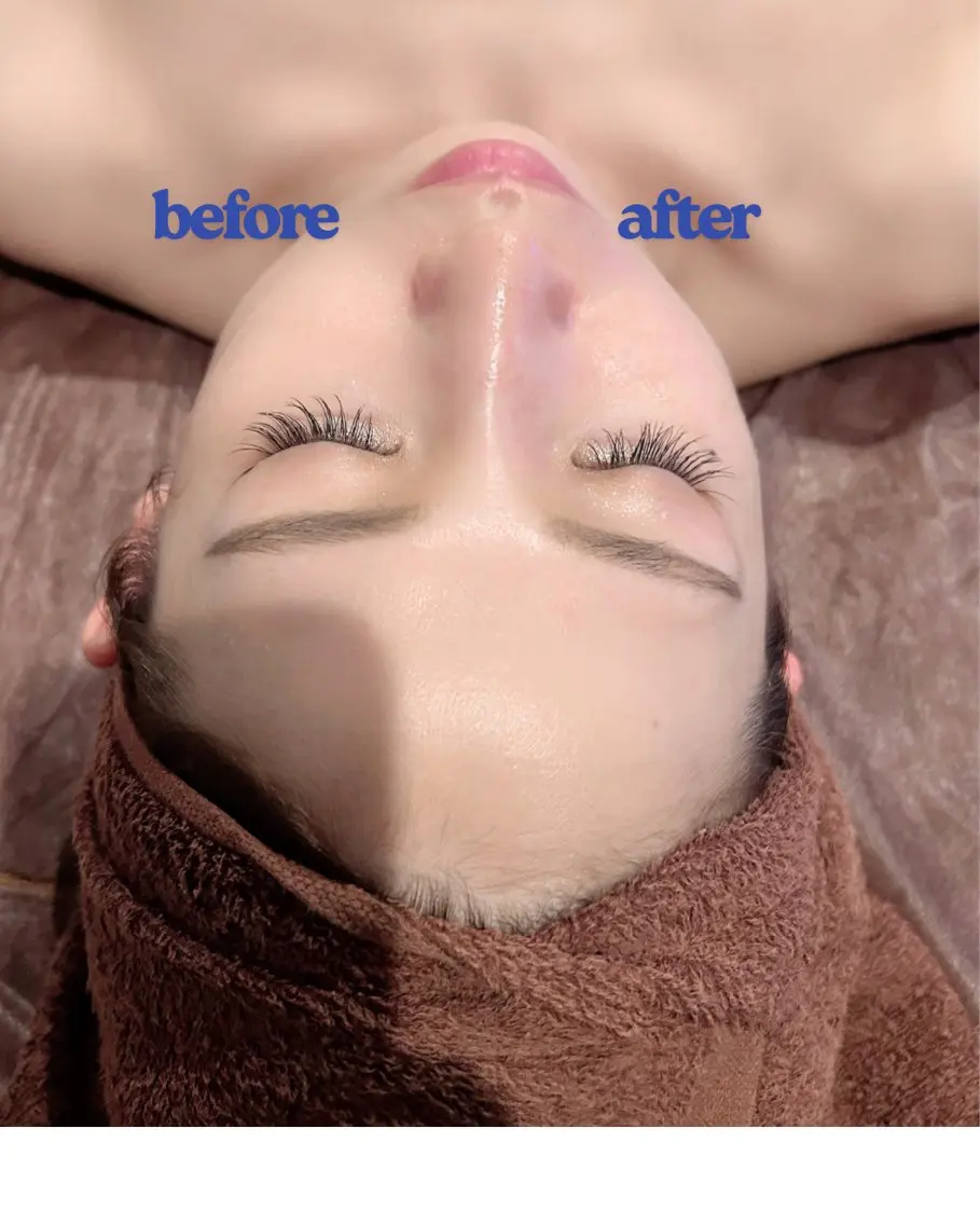エステサロンで出来る次世代糸リフト🧖♀️顔の引き上げ・顎のたるみ施術後すぐに実感😳✨の写真