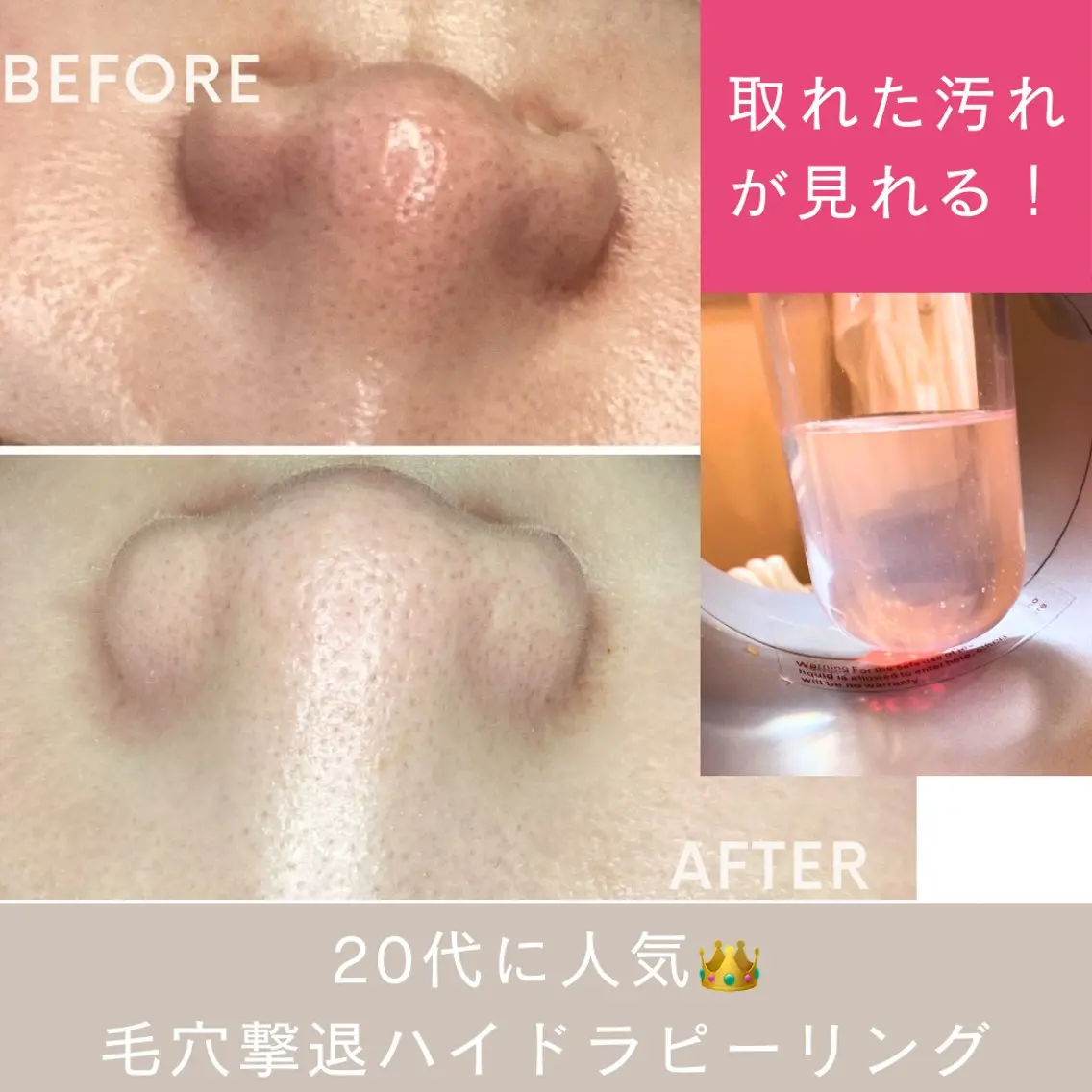 【全顔】ハイドラピーリングで吹き出物、毛穴汚れ、小鼻黒ずみを徹底洗浄⭐︎固まる美白ぷるんパック付の写真