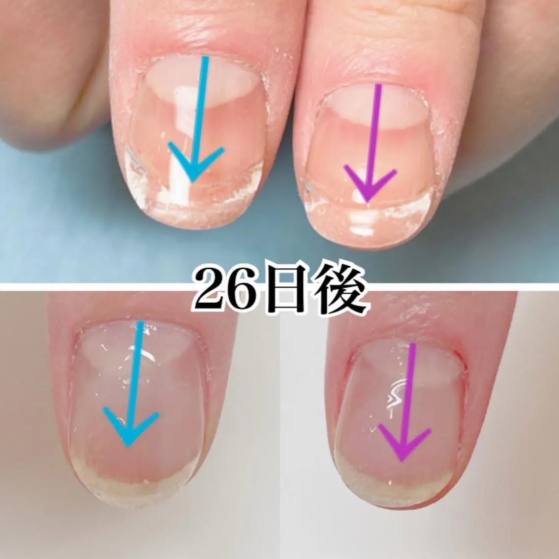深爪矯正【3ヶ月】ケア商品付きの写真