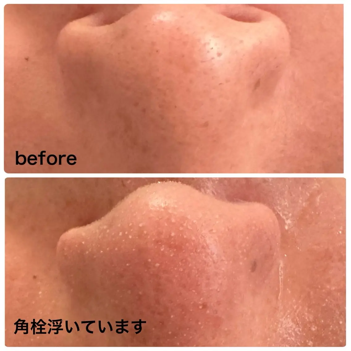 限定メニュー✨【黒ずみ毛穴洗浄×全顔導入付き】角栓ポップアップ洗浄！黒ずみ◎ざらつき◎ツルツル肌へ🌿✨の写真