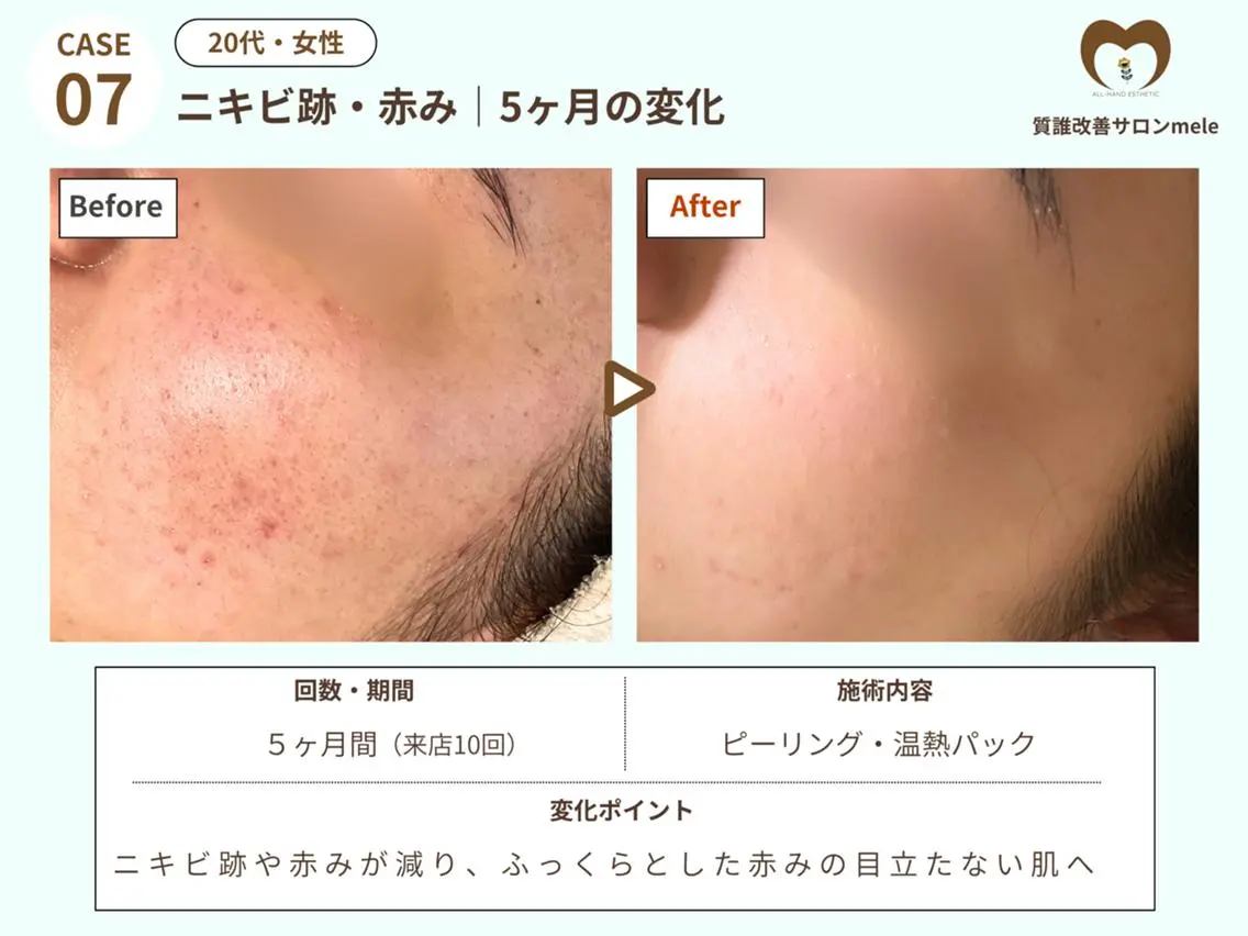 2回目以降【💆毛穴黒ずみ・開き・たるみに💆】角質除去 +温熱パック ¥21,000→¥17,500の写真