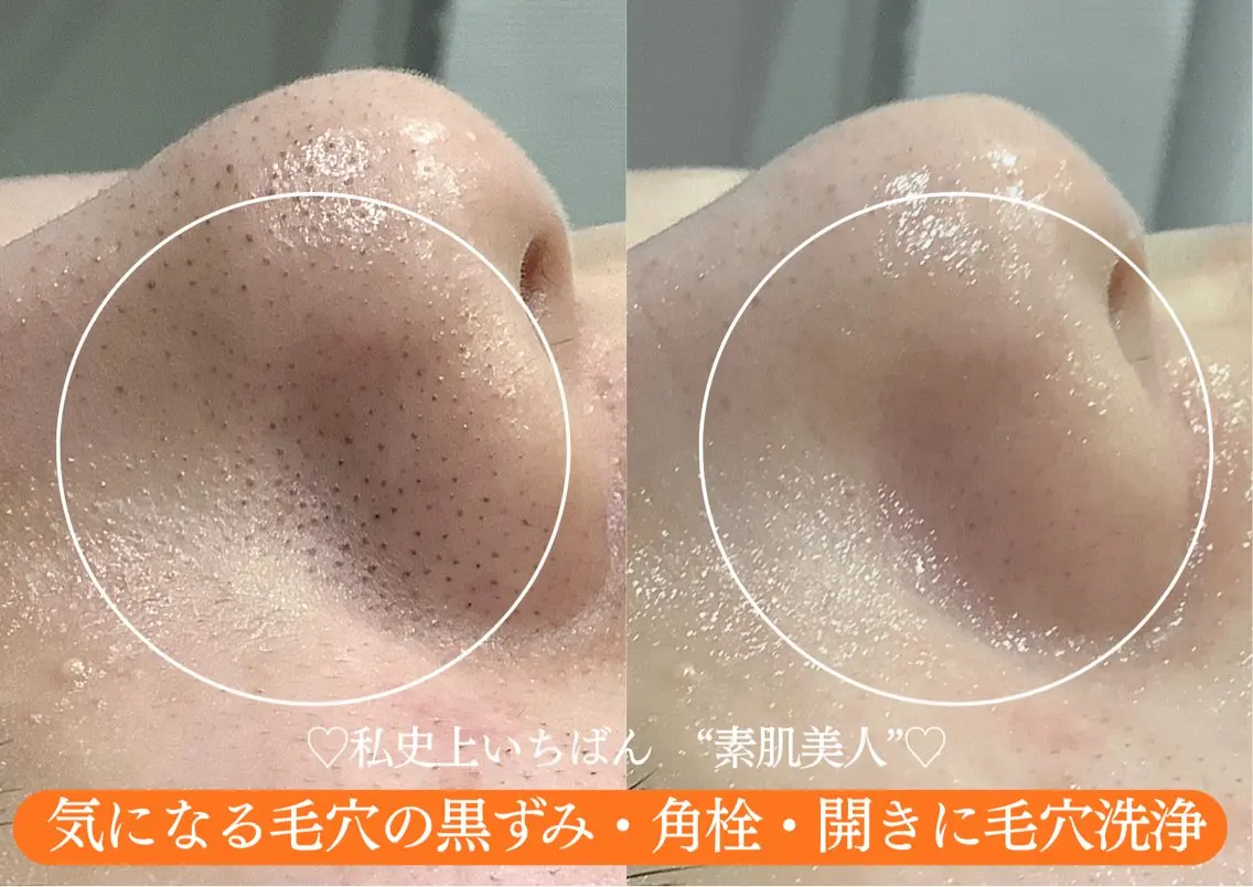 【夏前毛穴リセット】お顔丸ごと毛穴洗浄+肌診断付 ¥5,500→¥4,500の写真