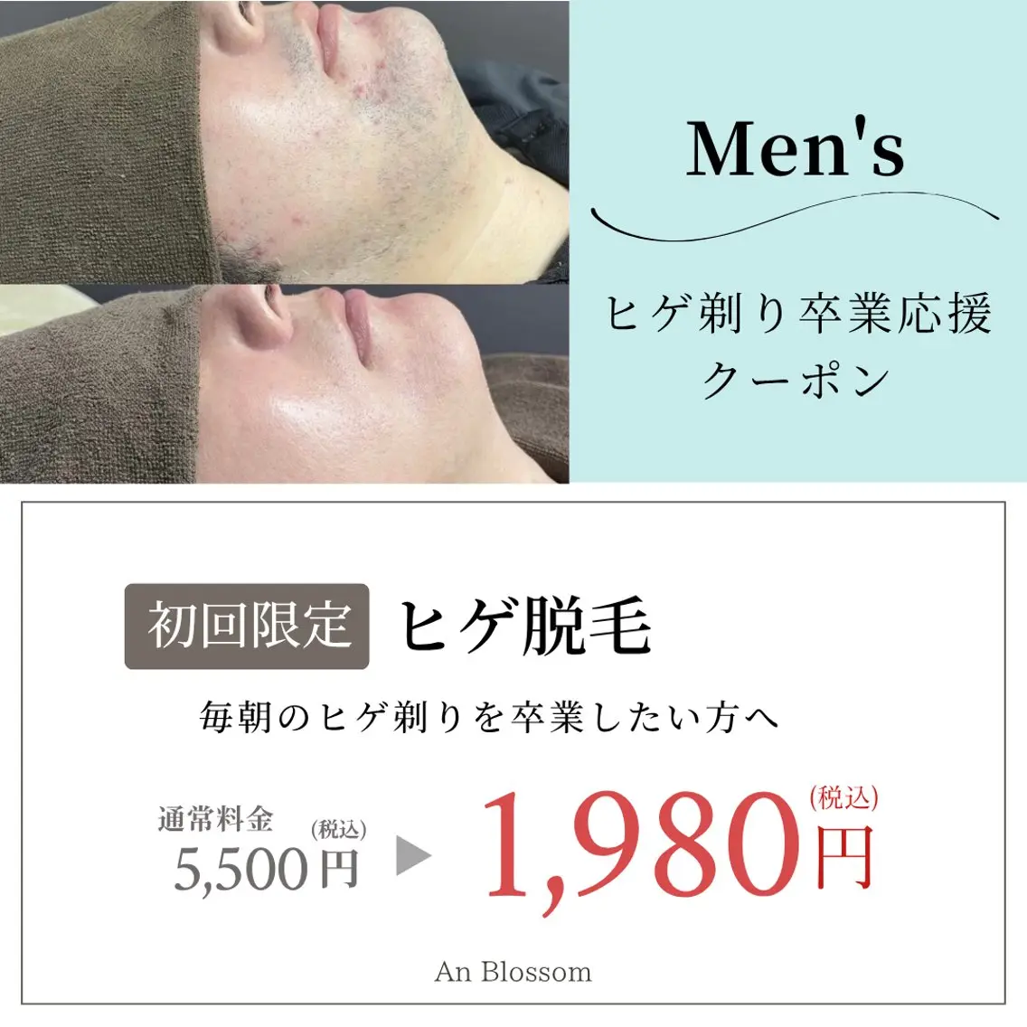 【初回5月限定🌿】👨💼メンズヒゲ脱毛✨清潔感upの写真