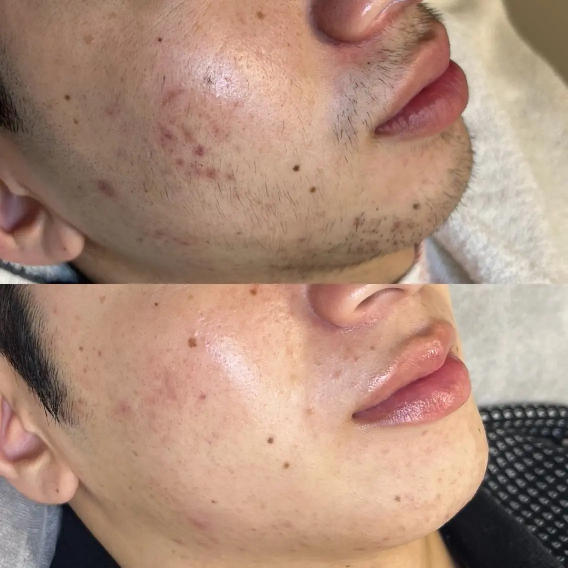 【メンズ/ヒゲ全体光脱毛¥2,000🧔🏽‍♂️】スキルアップレッスンモデルの写真