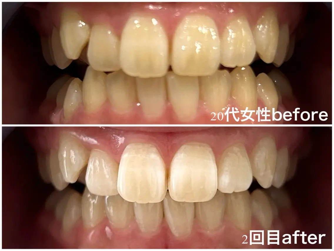 セルフホワイトニング30分 【2回】の写真
