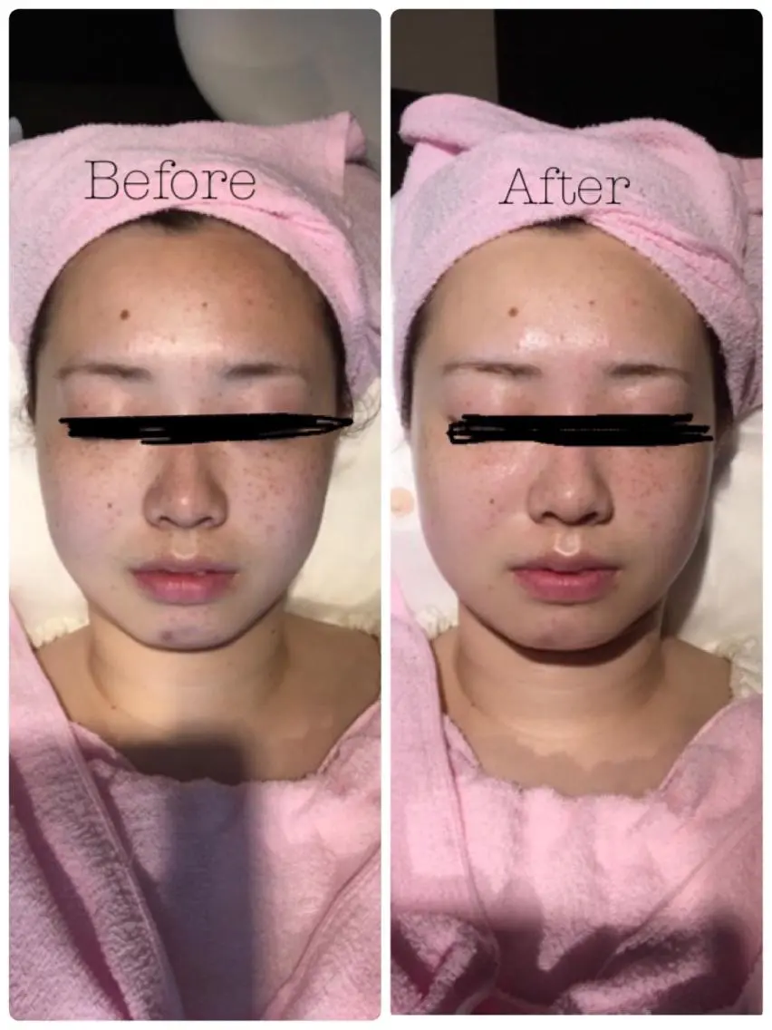 美白最大級コース★全てのトラブル解決!の写真