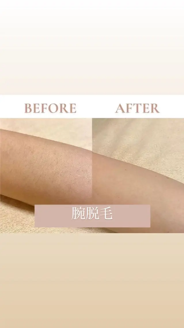 【自己処理の手間•しつこいムダ毛に】🌟腕まるごと(指先まで)🌟の写真