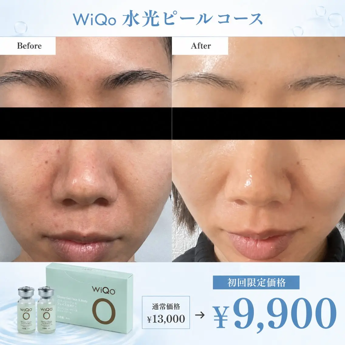 【ハリ・ツヤ・毛穴】浸透型ピーリングでコラーゲン促進🌱保湿ケアも◎エレクトロポレーション&パック付きの写真