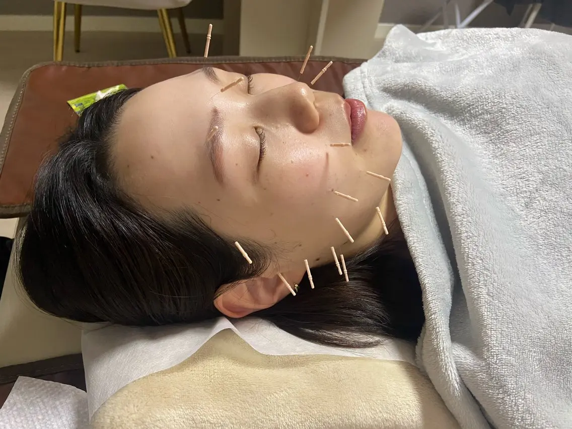 継続クーポン🪡小顔美容鍼の写真