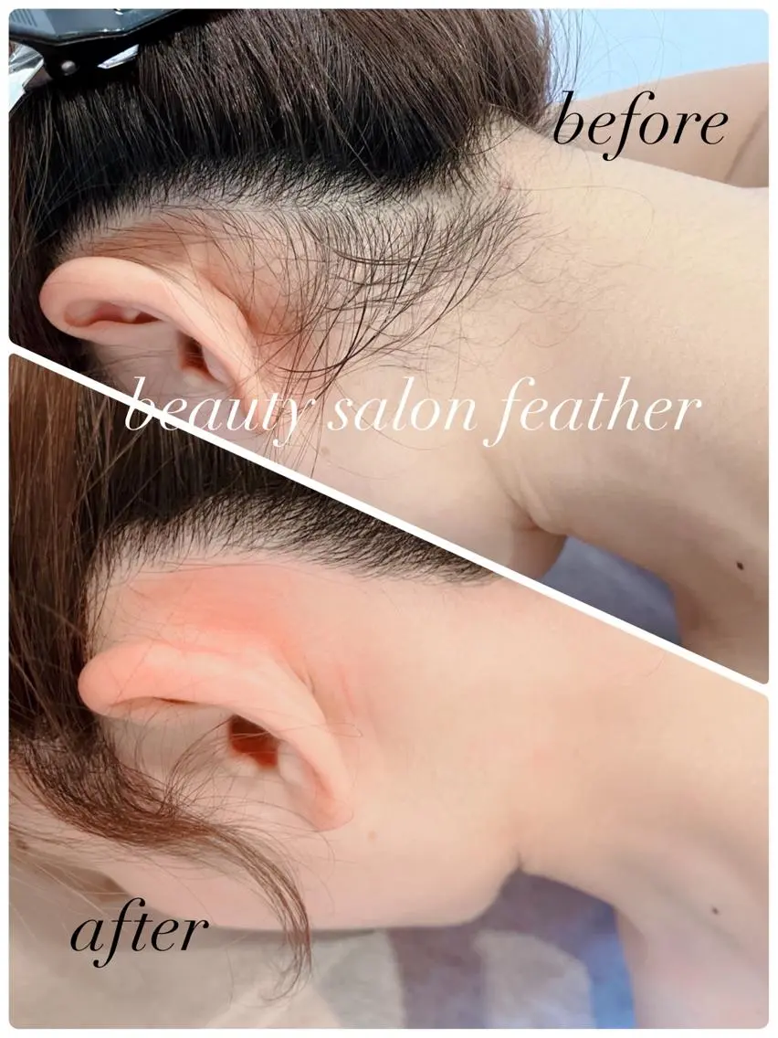 うなじWax脱毛と光脱毛のセットの写真