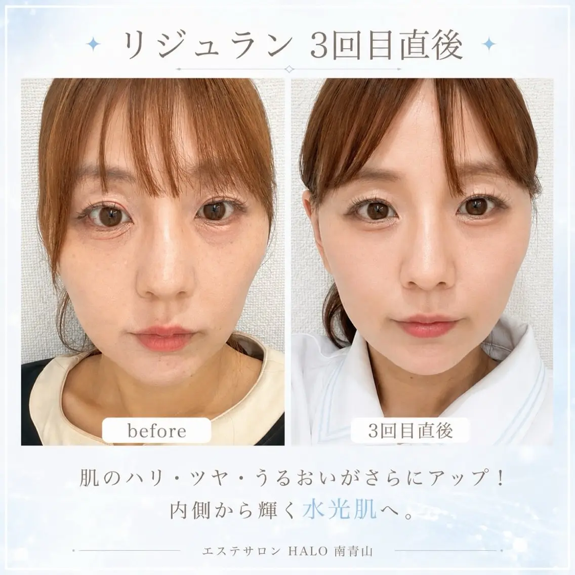 【80分】HALO式コケない小顔◆レモン×PNリジュラン【モニター様募集】の写真