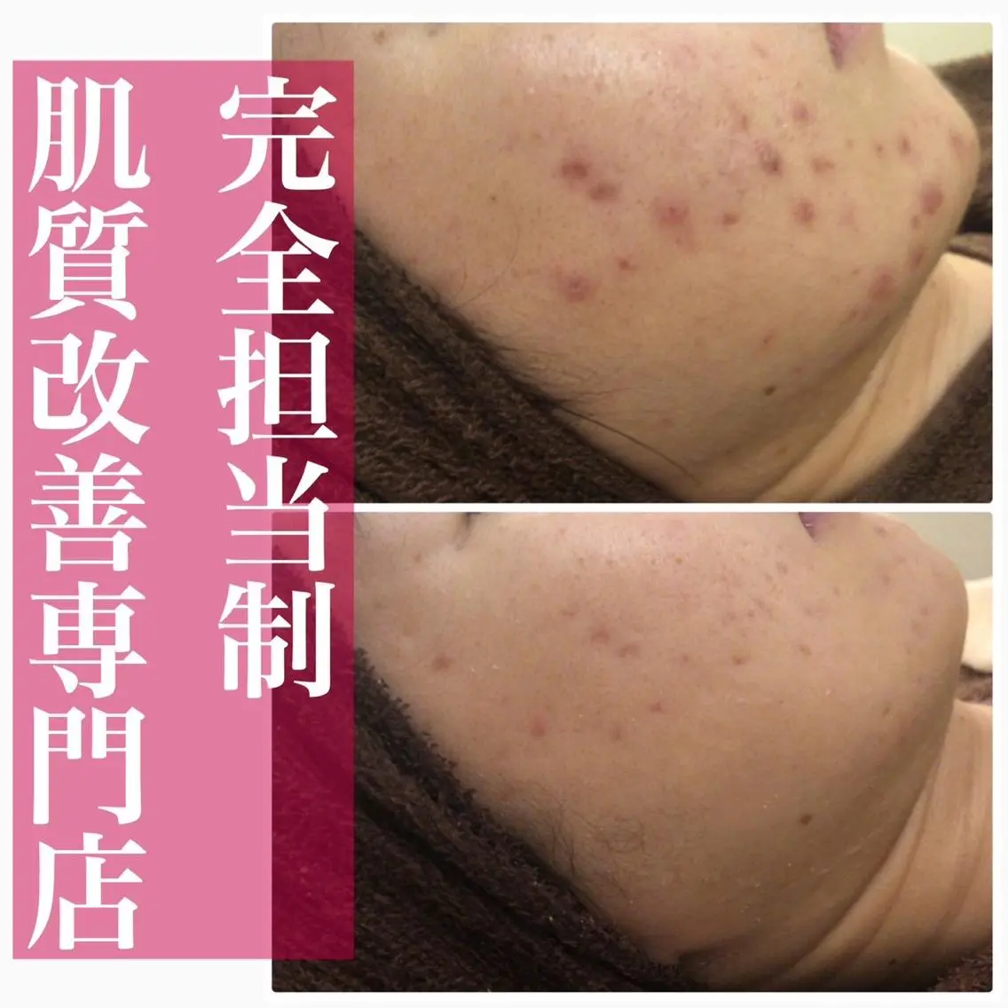 セミロング カラー パーマ ヘアアレンジ メンズ キッズ ネイル マツエク・マツパ アイブロウ 3か月で肌革命👼 ニキビ専門店💫のエステ・リラクイメージ