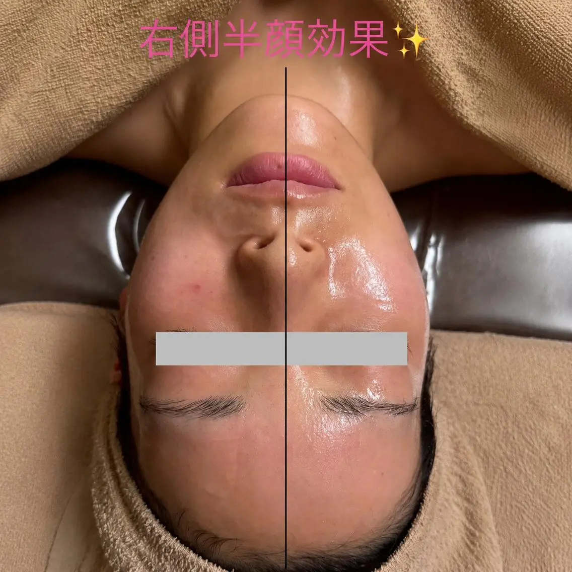 【小顔×肌質改善🫧】毛穴・ニキビ・くすみ改善🌸毛穴レス、リフトアップフェイシャル🥰の写真