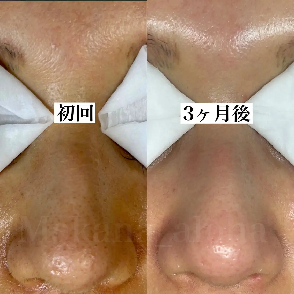 毛穴詰まり解消60分コースの写真