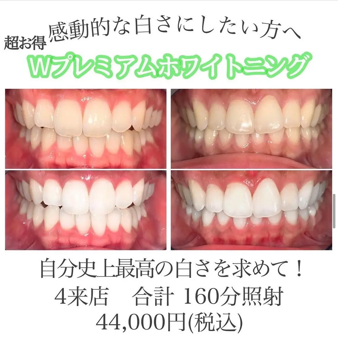 【超絶お得なプラン】Wプレミアムホワイトニング 4 来店計160分照射 徹底的な白さへ🦷✨の写真