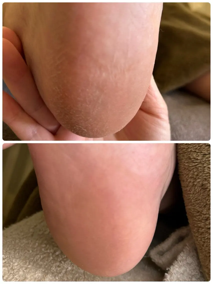 足裏角質ケア フットバス+足裏の角質ケア+保湿付き✨の写真