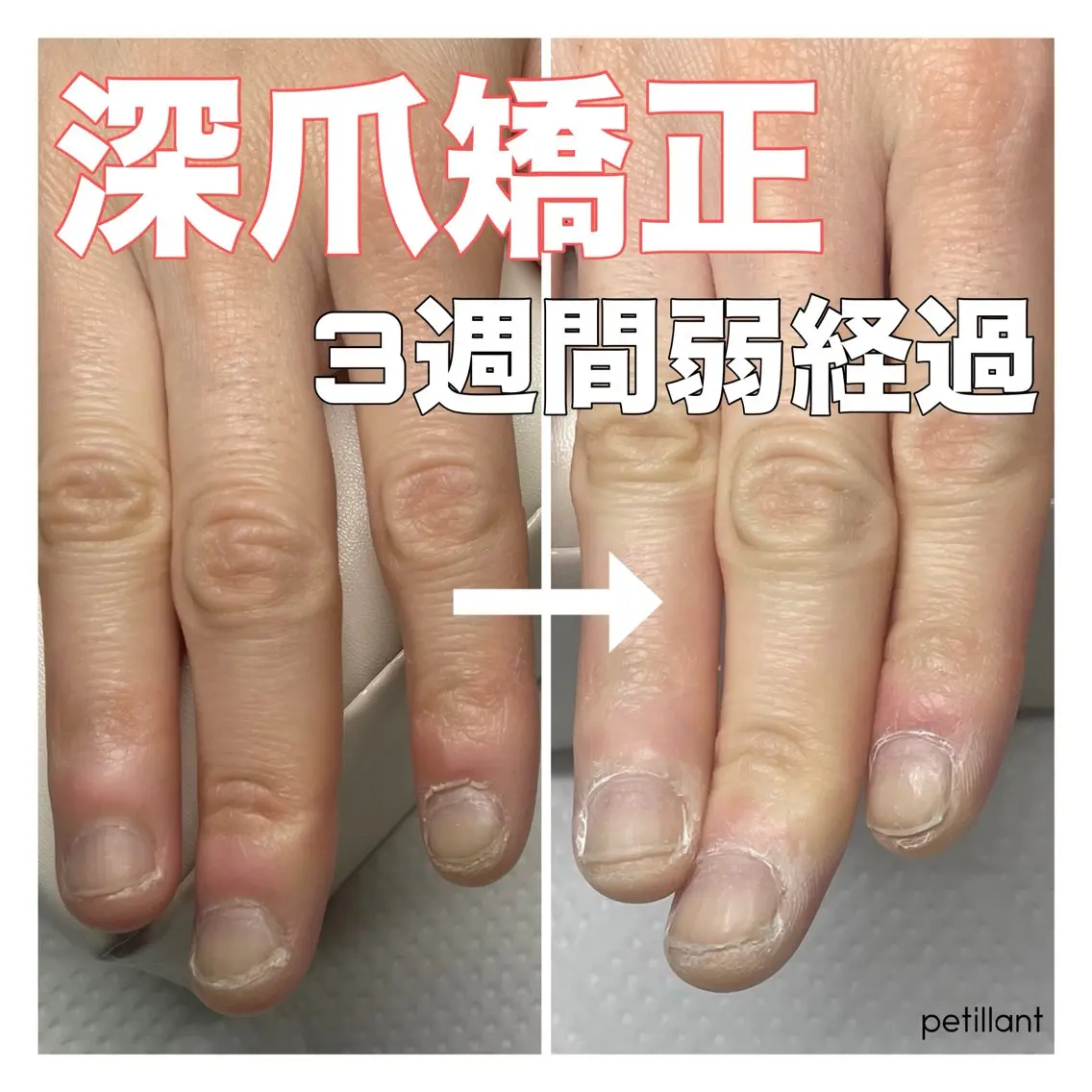 ネイル 長さ出し ピンク nail salon petillantのネイルデザイン