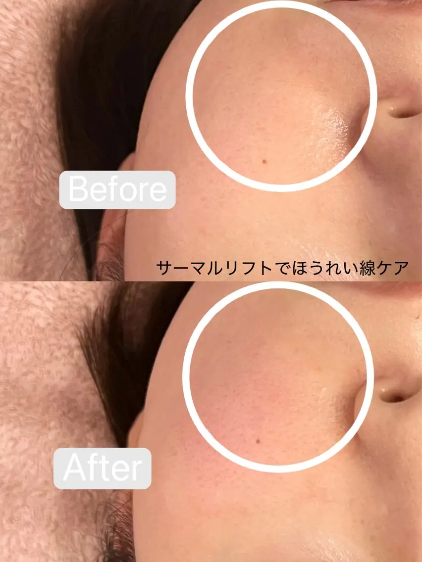 エステ 小顔&毛穴・肌質改善 LINDA西宮 AIのエステ・リラクイメージ
