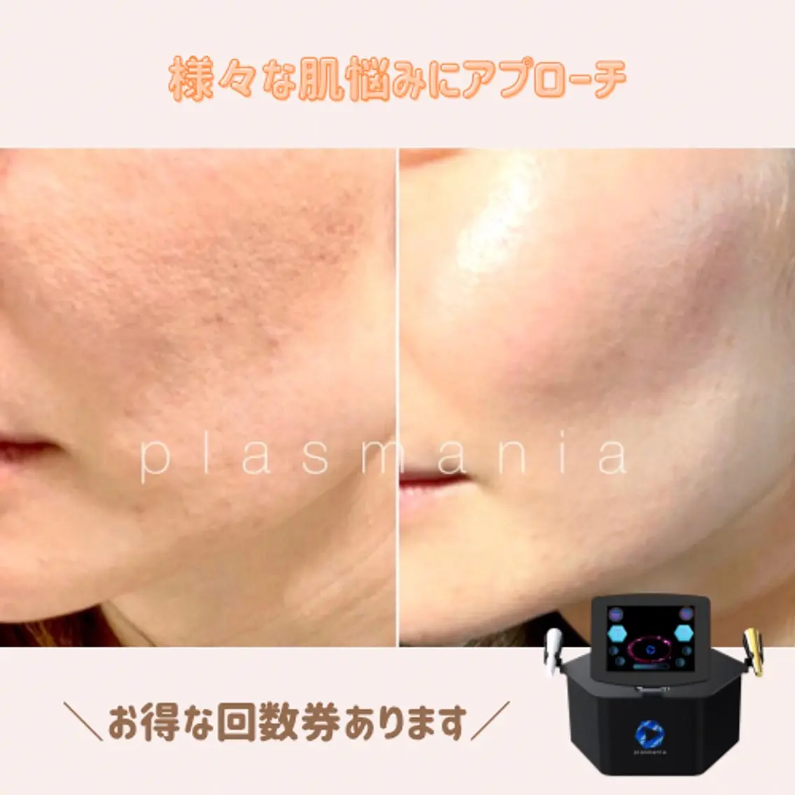 《3回コース》史上最高の肌への近道✨の写真