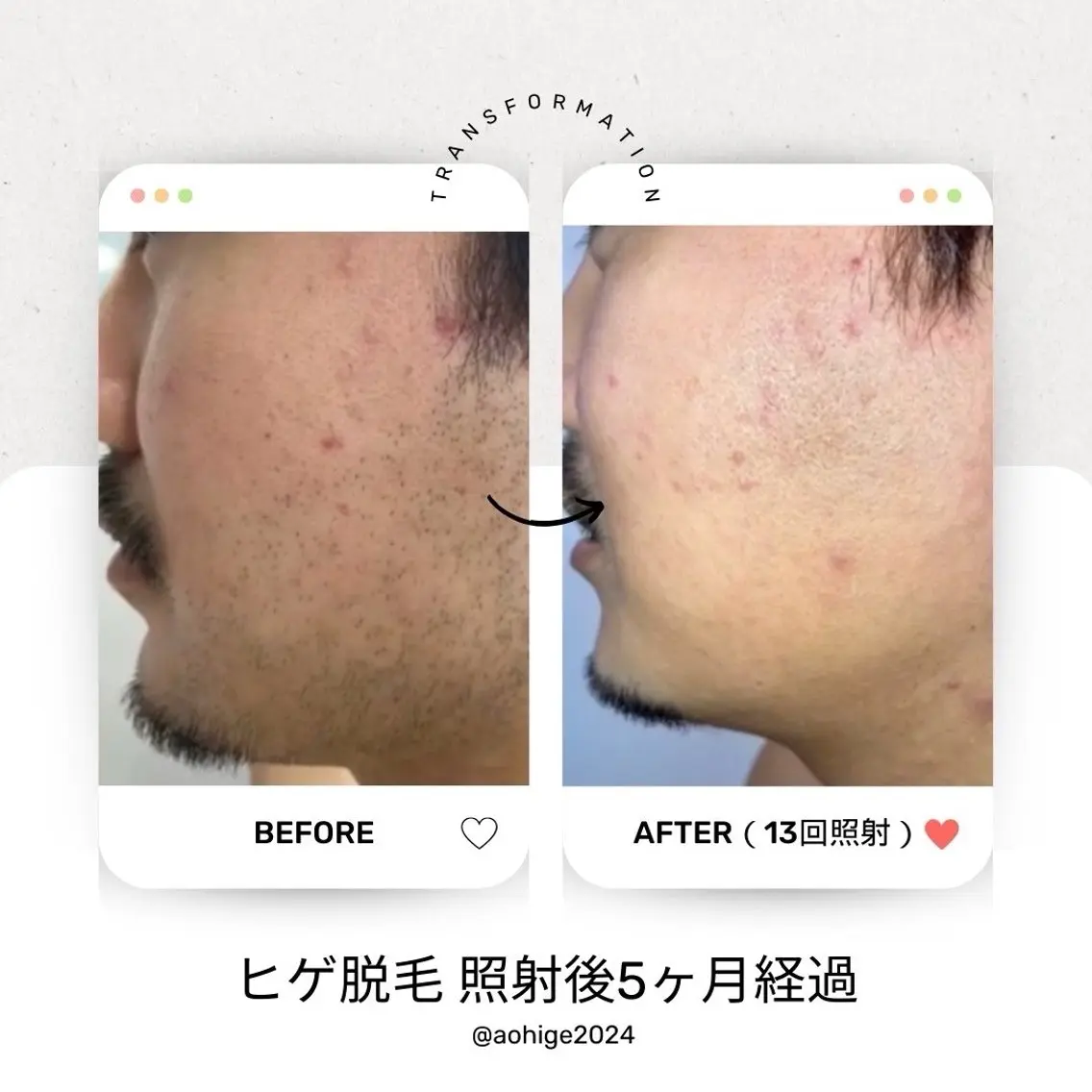 《メンズ清潔感UP👔》単発ヒゲ脱毛｜青ヒゲ・肌荒れ・毎朝の髭剃り対策✨の写真