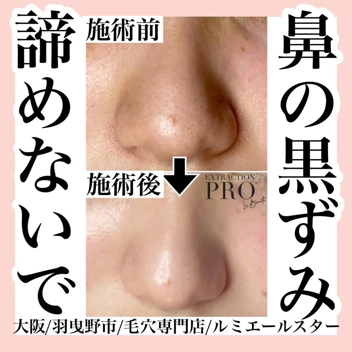 エステ 最速 毛穴シミ改善 いくえのその他イメージ