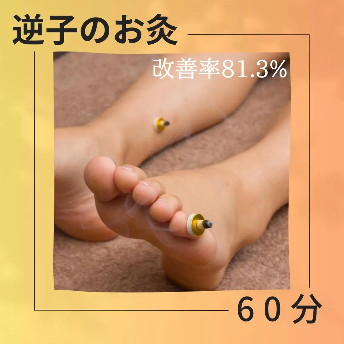 【改善実績81.3%】逆子の灸コースの写真