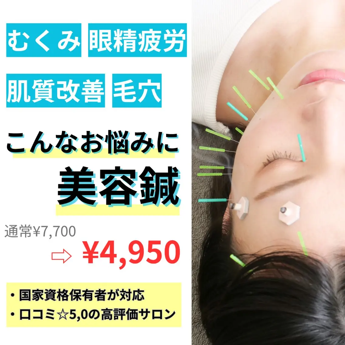 【💫ヘッドスパ無料!?💫 】美容鍼スタンダードコース 7700→4950の写真
