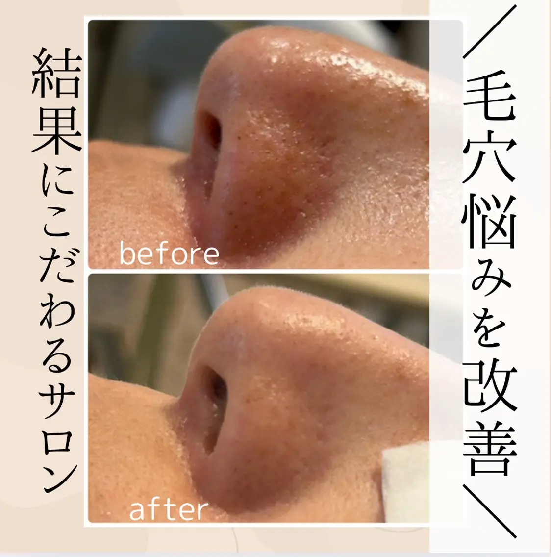【小顔＆毛穴ひきしめフェイシャル】黒ずみ・角栓徹底除去➕毛穴ひきしめ保湿パック付きの写真