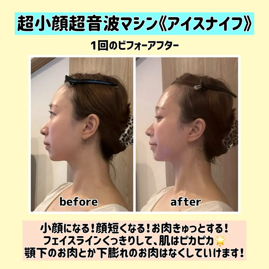 【写真モニター募集】超小顔超音波マシン《アイスナイフ》の写真