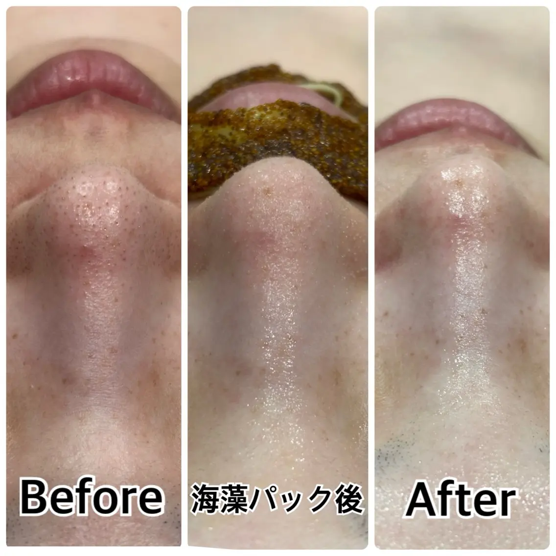 【新規男女/花粉や皮脂対策で透明肌へ】全顔3D毛穴洗浄体験¥5500の写真