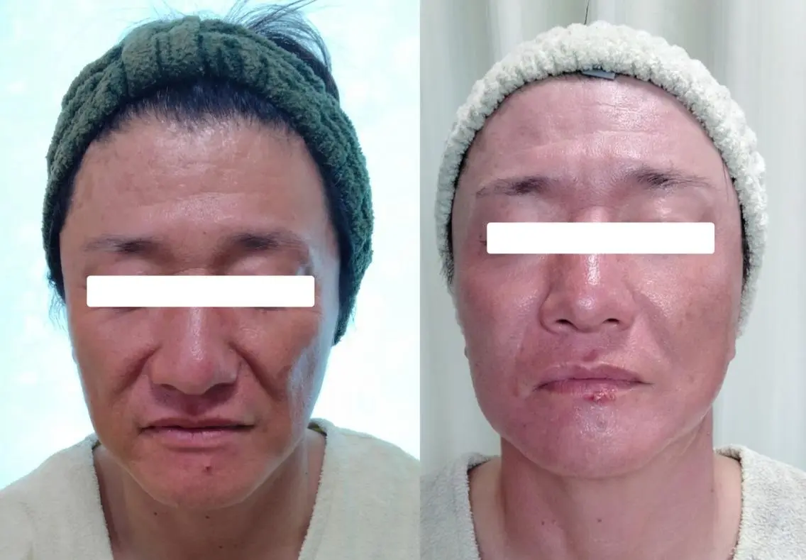 【メンズ小顔】デキる男の第一印象アップ!即効小顔フェイシャル 17,400円の写真
