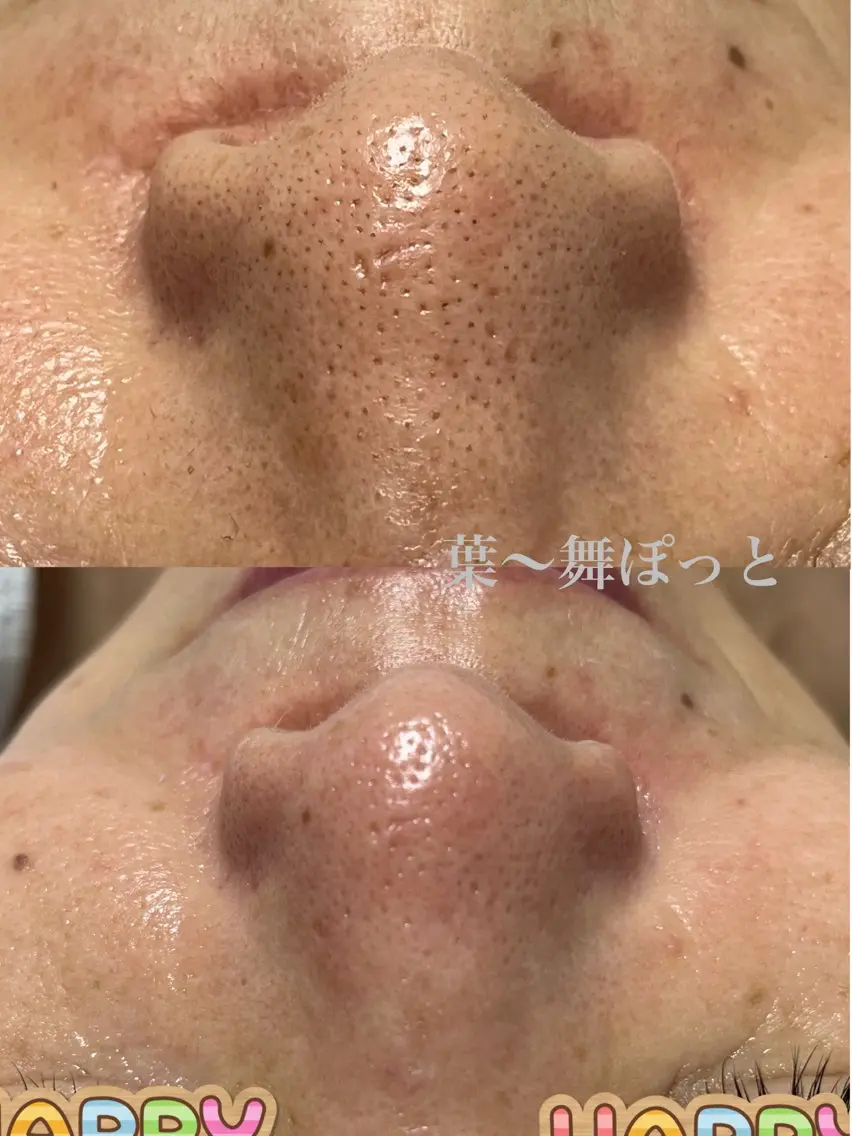 毛穴黒ずみ、つまりを爽快にリフレッシュ 毛穴エクストラクション&シュガーリング脱毛スキンケア&プルプル肌パックの写真