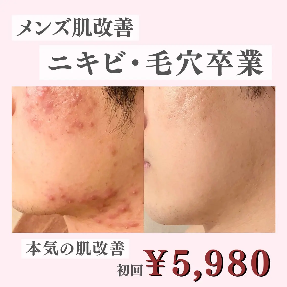 【メンズ限定👨】毛穴詰まり/頑固なニキビ/髭剃り負けに🪒低刺激ピーリング+集中肌補修Wパックでモテ肌に🤍✨の写真