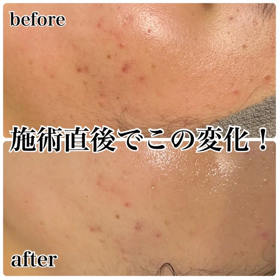 【ニキビ肌・毛穴改善】Reviハーブピーリング!効果倍増のエンザイム付き◎全顔+首の写真