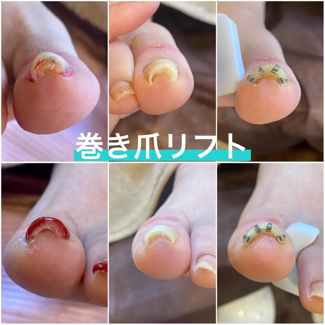 ネイル ♢ME2ROOM♢ #巻き爪#リラクのネイルデザイン