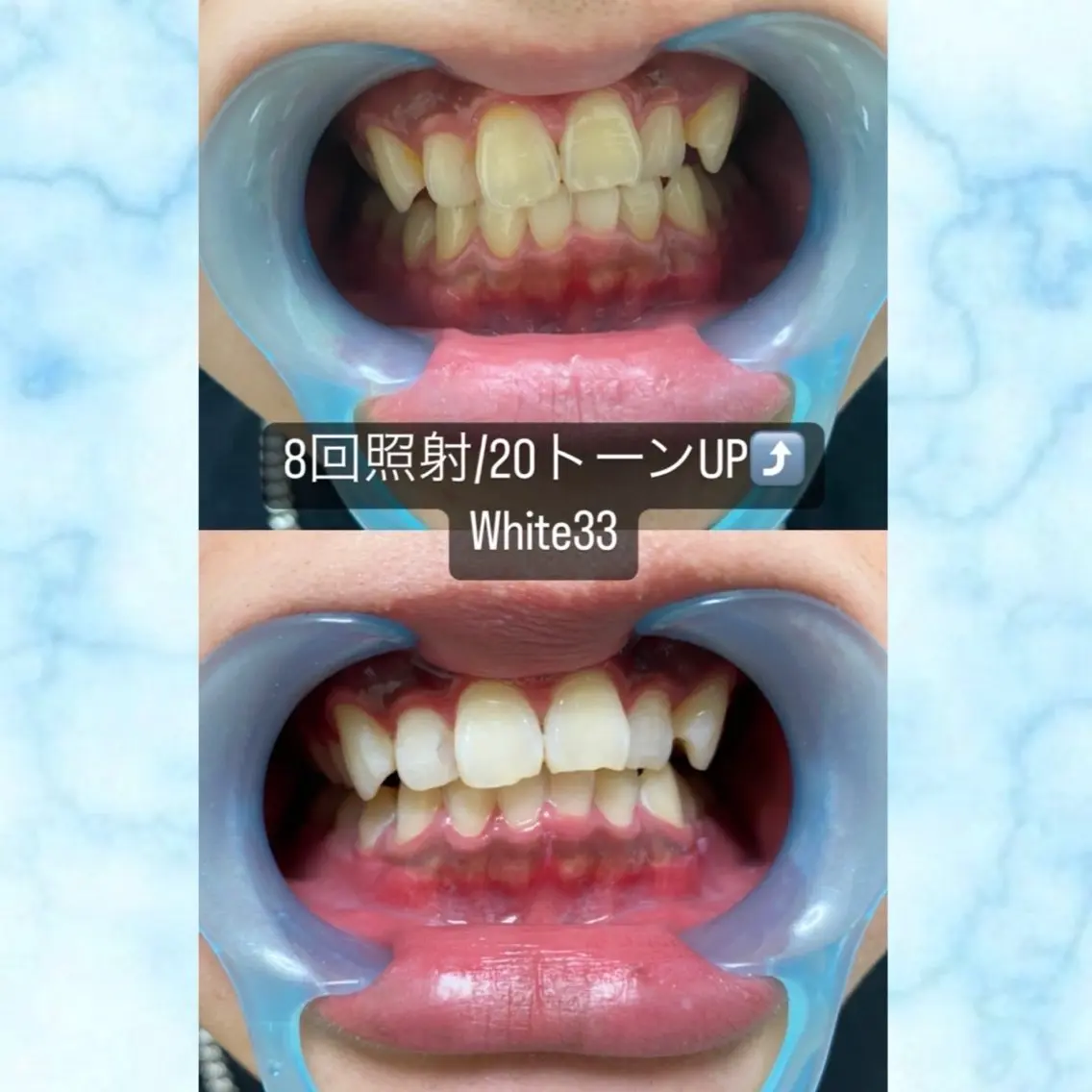 【再来】高性能セルフホワイトニング　18000円の写真