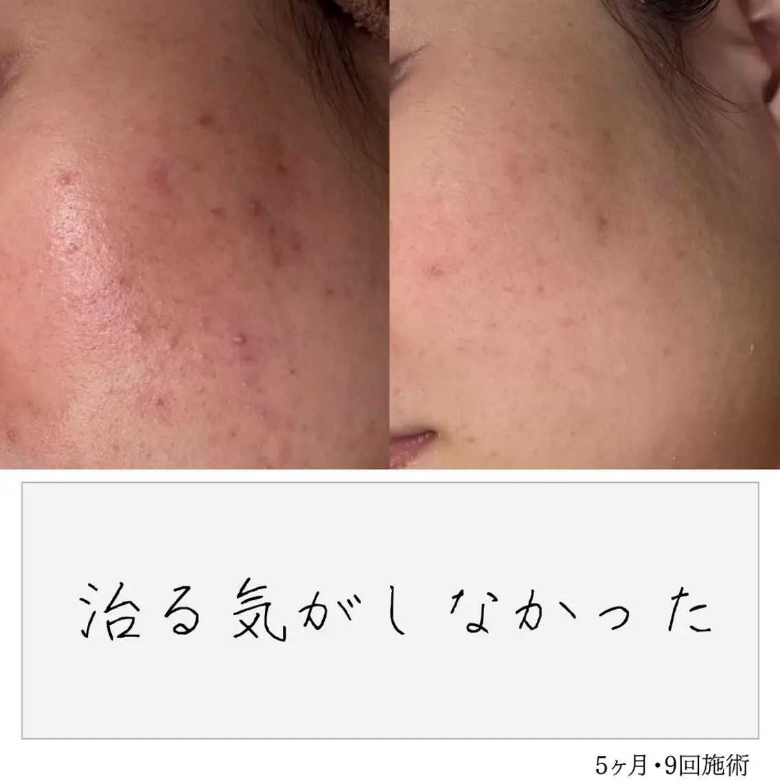 ニキビ経験者が施術 する専門サロン🌻のエステ・リラクイメージ