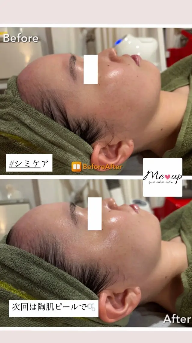 エステ Meup ニキビケア 毛穴・背中ニキビ専門のエステ・リラクイメージ