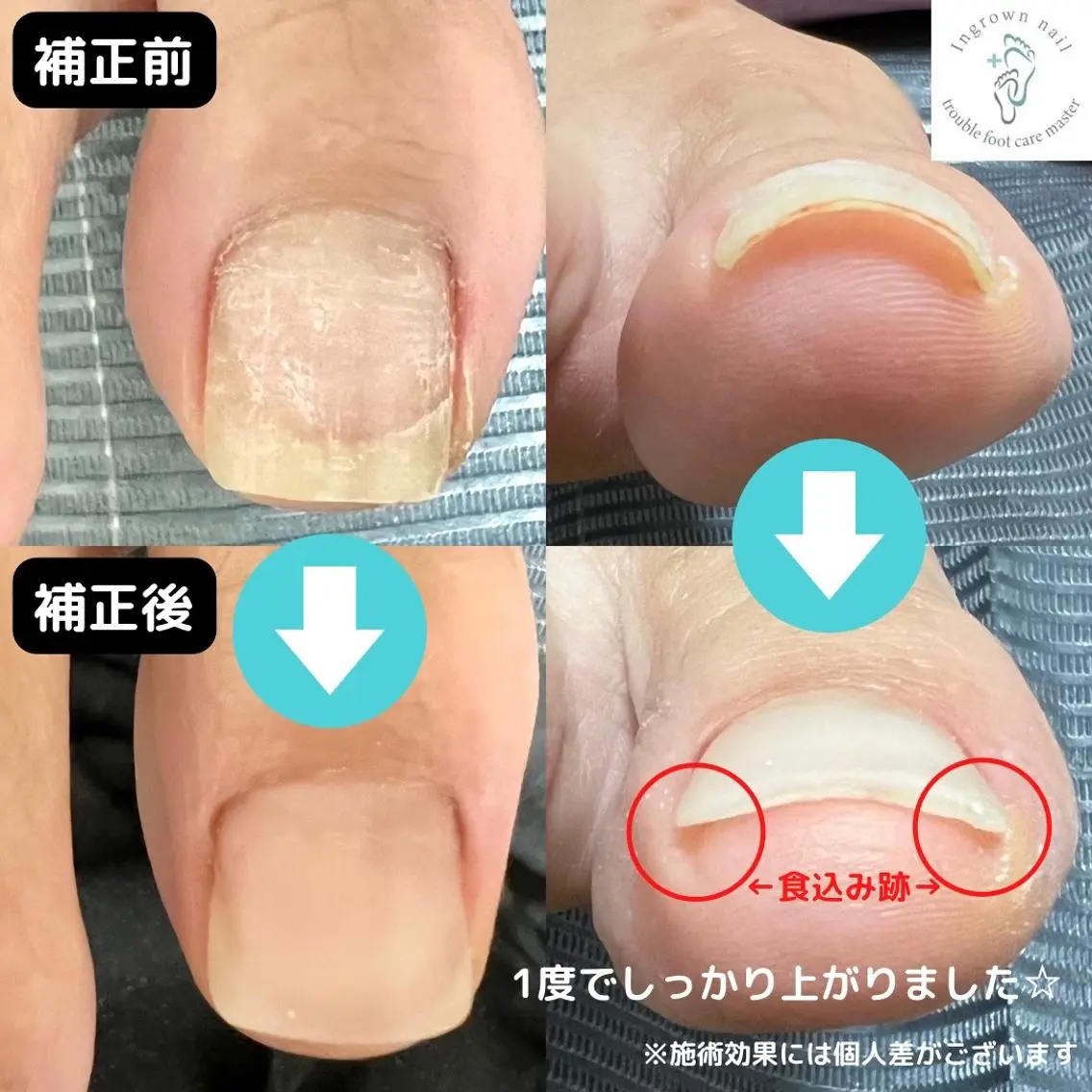 巻き爪、変形爪、肥厚爪、魚の目など(足のあらゆるお悩みに対応☆手も可)の写真