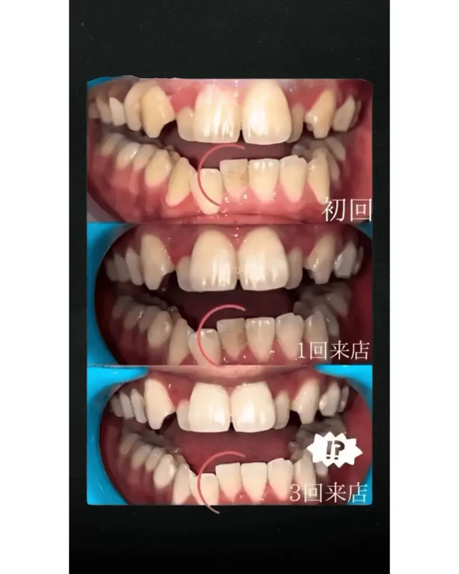 東区香椎歯のセルフホ ワイトニングGLOWのその他イメージ