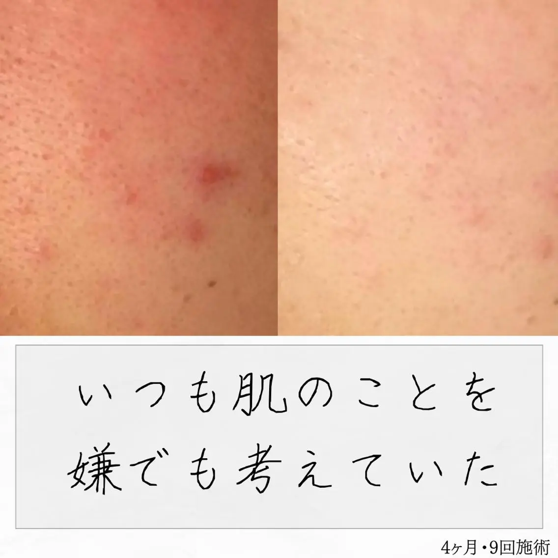 ニキビ経験者が施術 する専門サロン🌻のエステ・リラクイメージ