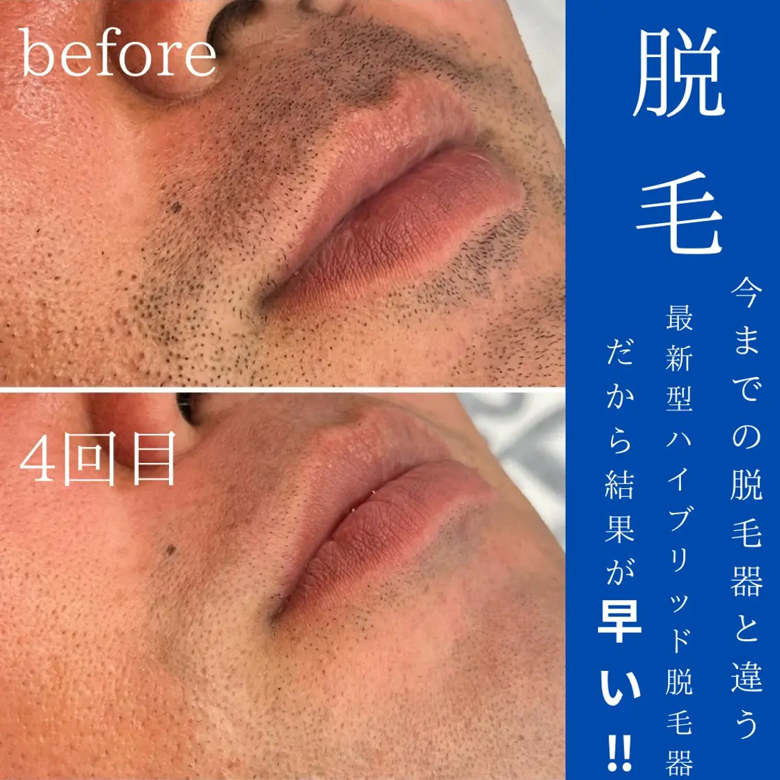 WAX・肌質改善・毛 穴洗浄/林愛真のエステ・リラクイメージ