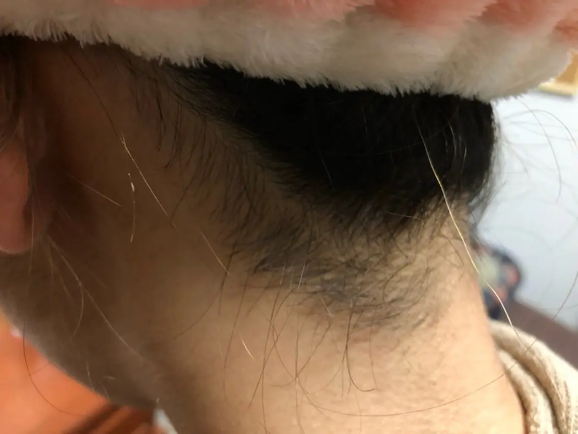 ハイブリッドえりあし脱毛の写真