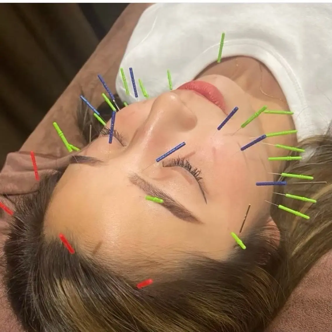 ✨️💐美容鍼➕電気➕リンパマッサージ💐✨️の写真