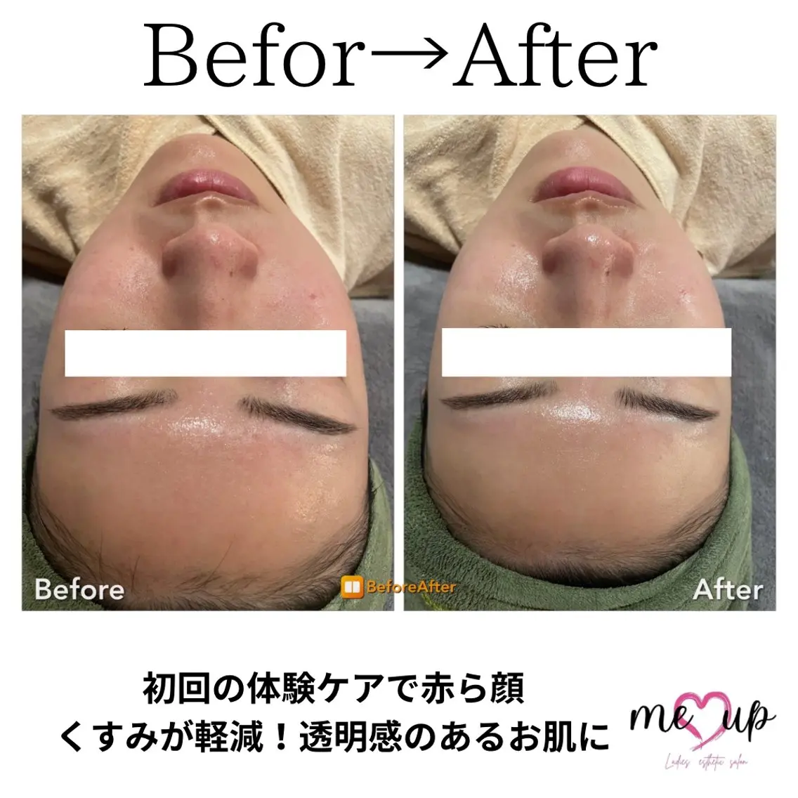 Meupニキビ専門店 背中/ハーブ/肌管理のその他イメージ