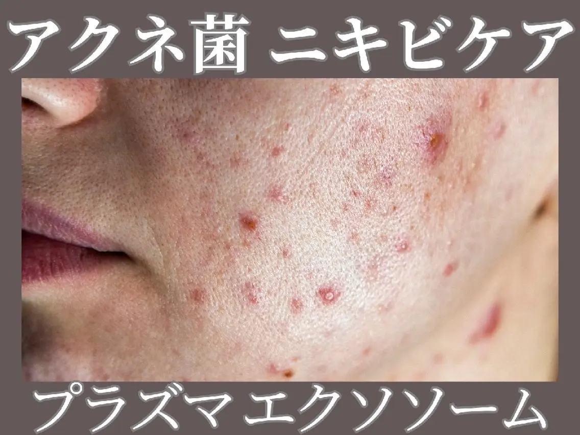 ニキビケアはこれ！プラズマダーマ＋プラズマパックの写真