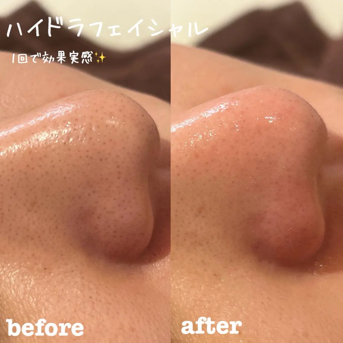 【2回通える🌟毛穴詰まりリセット🧼】お肌がうるおう🚿毛穴洗浄×インナーケアカウンセリング付【口コミ価格】の写真