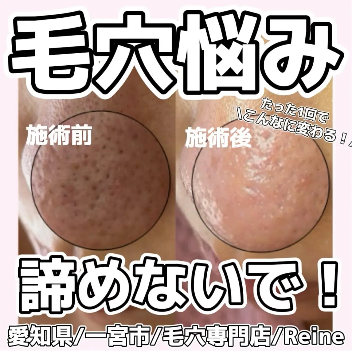 毛穴/シミ肝斑/脱毛 横山梨里のエステ・リラクイメージ