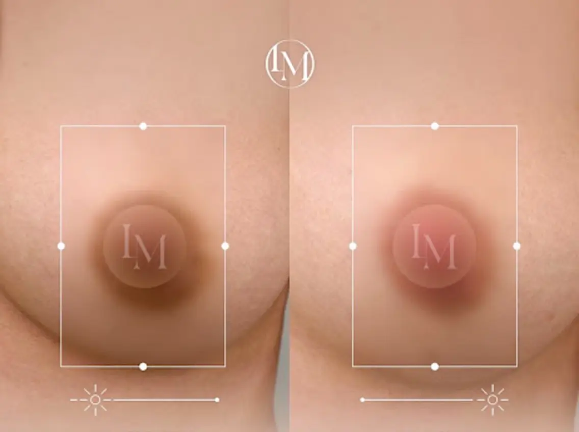 メラニンケア　乳輪の写真