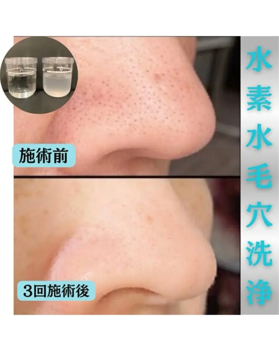 リピート人気NO.1毛穴洗浄コースの写真